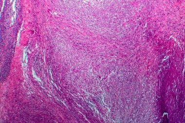 Hodgkin lenfoması, hafif mikrograf, mikroskop altında fotoğraf.