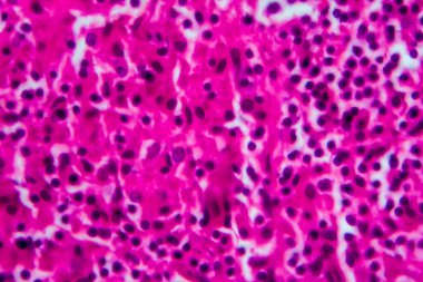 Hodgkin olmayan lenfoma, hafif mikrograf, mikroskop altında fotoğraf. Yüksek büyütme