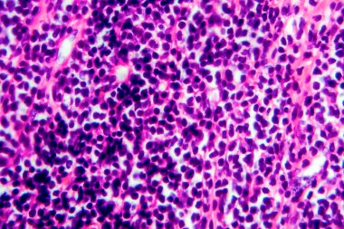 Hodgkin lenfoması, hafif mikrograf, mikroskop altında fotoğraf.