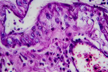 İdrar kesesi hücre kanseri, hafif mikrograf, mikroskop altında fotoğraf. Yüksek büyütme