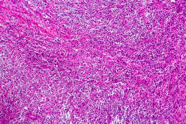 Hodgkin lenfoması, hafif mikrograf, mikroskop altında fotoğraf.