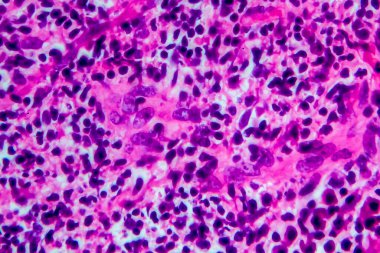 Hodgkin lenfoması, hafif mikrograf, mikroskop altında fotoğraf. Yüksek büyütme