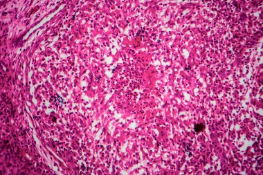 Böbrek tüberkülozu, hafif mikrograf, mikroskop altında fotoğraf.