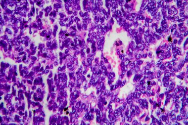 Wilms tümörü, nefroblastoma, hafif mikrograf, mikroskop altında fotoğraf. Yüksek büyütme