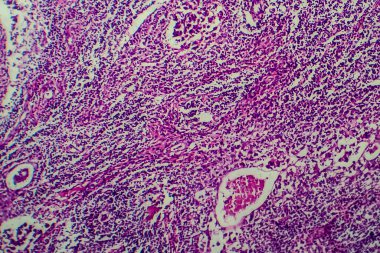 Hodgkin lenfoması, hafif mikrograf, mikroskop altında fotoğraf.