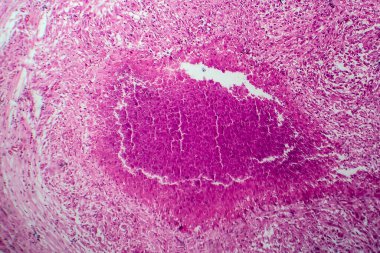 Böbrek tüberkülozu, hafif mikrograf, mikroskop altında fotoğraf.