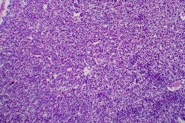 Wilms tümörü ya da nefroblastoma, ışık mikrografı, mikroskop altında fotoğraf.