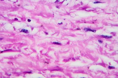 Hodgkin lenfoması, hafif mikrograf, mikroskop altında fotoğraf. Yüksek büyütme