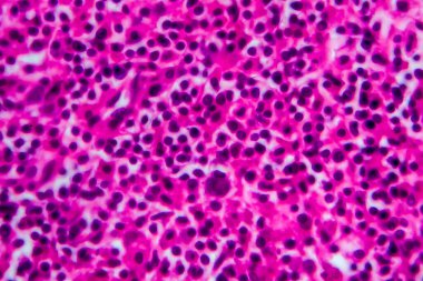 Hodgkin olmayan lenfoma, hafif mikrograf, mikroskop altında fotoğraf. Yüksek büyütme