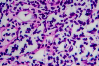 Hodgkin lenfoması, hafif mikrograf, mikroskop altında fotoğraf. Yüksek büyütme