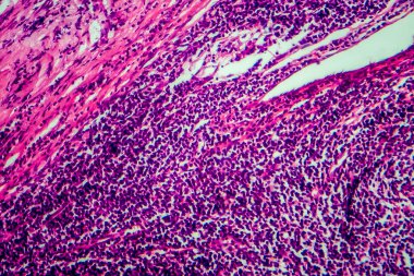 Hodgkin lenfoması, hafif mikrograf, mikroskop altında fotoğraf.