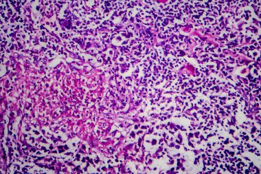 Hodgkin lenfoması, hafif mikrograf, mikroskop altında fotoğraf.