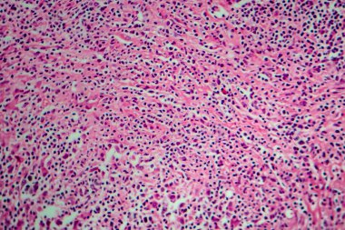 Hodgkin lenfoması, hafif mikrograf, mikroskop altında fotoğraf.