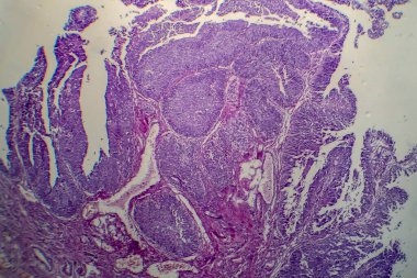 Mesane hücre kanseri, hafif mikrograf, mikroskop altında fotoğraf.