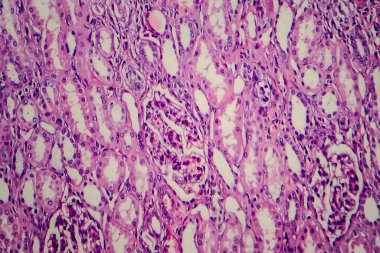 Wilms tumor, or nephroblastoma, light micrograph, photo under microscope clipart