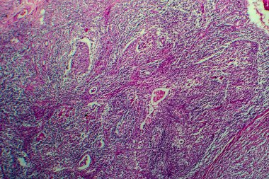 Hodgkin lenfoması, hafif mikrograf, mikroskop altında fotoğraf.