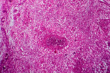 Böbrek tüberkülozu, hafif mikrograf, mikroskop altında fotoğraf.