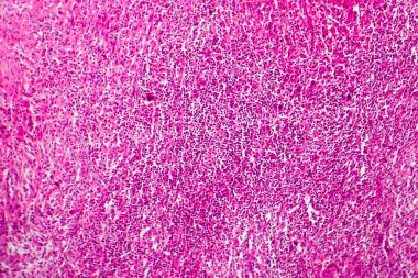 Hodgkin olmayan lenfoma, hafif mikrograf, mikroskop altında fotoğraf.