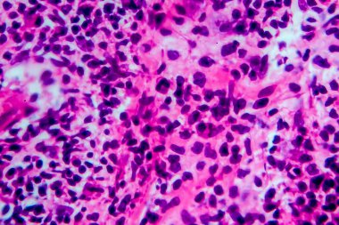 Hodgkin lenfoması, hafif mikrograf, mikroskop altında fotoğraf. Yüksek büyütme