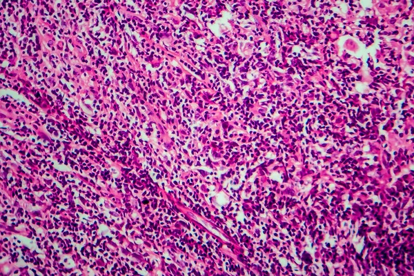 ホジキンリンパ腫光マイクログラフ顕微鏡下の写真 — ストック写真