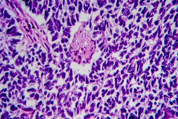 Wilms tumor, or nephroblastoma, light micrograph, photo under microscope. High magnification