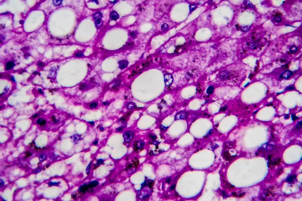 Histopathology of alcoholic hepatitis, light micrograph, photo under microscope. High magnification