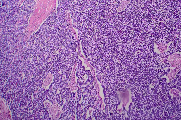 Tumor Wilms Nefroblastoma Micrografía Ligera Foto Bajo Microscopio —  Fotos de Stock