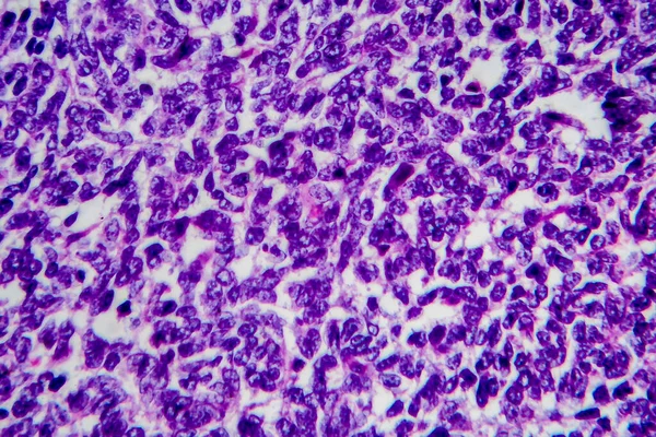 Wilms tumor, or nephroblastoma, light micrograph, photo under microscope. High magnification