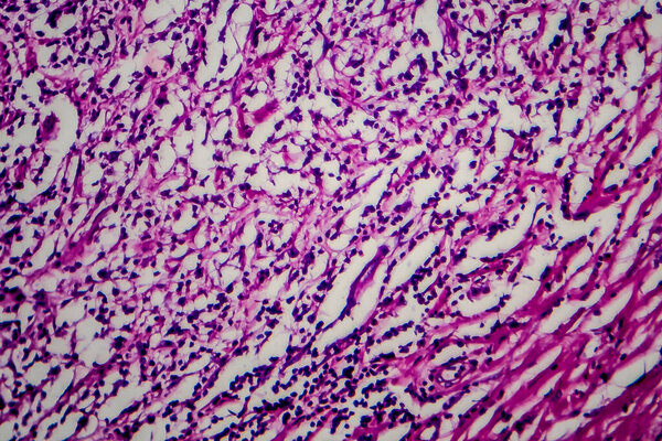Hodgkin's lymphoma, light micrograph, photo under microscope