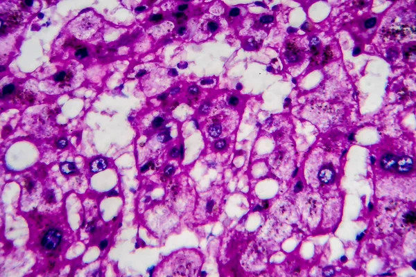 Histopatologia Hepatite Alcoólica Micrografia Luz Foto Sob Microscópio Elevada Ampliação — Fotografia de Stock