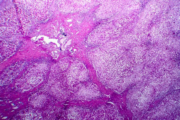 Histopatología Hepatitis Alcohólica Micrografía Ligera Foto Bajo Microscopio — Foto de Stock