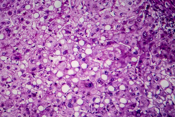알코올 간염의 마이크로 그래프 현미경으로 — 스톡 사진