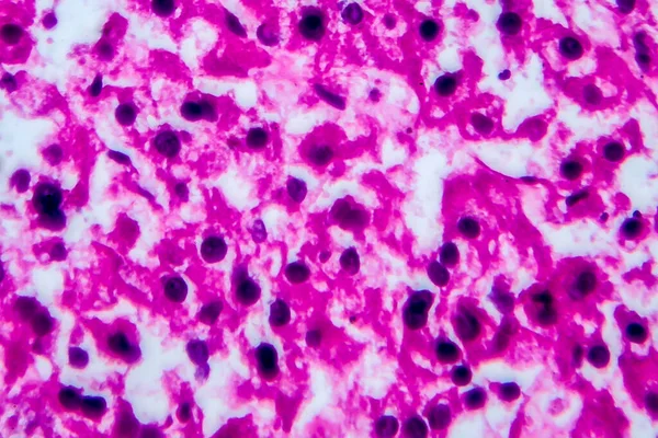 Carcinoma Células Renales Micrografía Ligera Foto Bajo Microscopio Alto Aumento — Foto de Stock