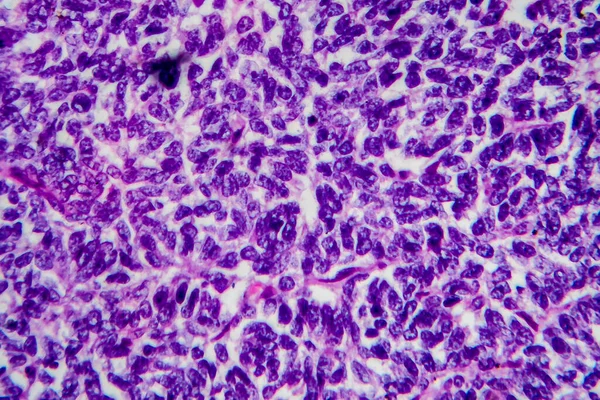 Wilms tumor, or nephroblastoma, light micrograph, photo under microscope. High magnification