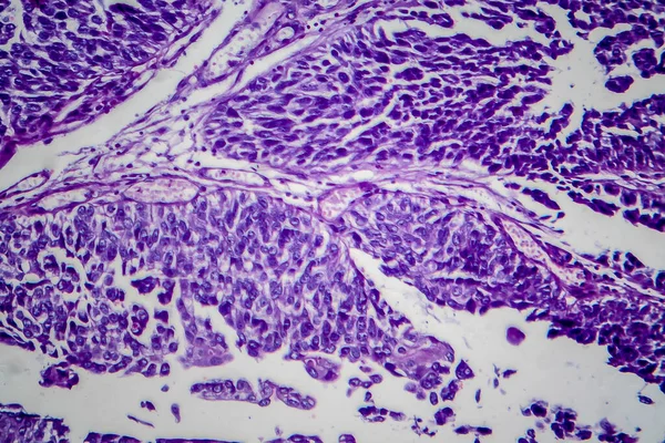 Přechodný Buněčný Karcinom Močového Měchýře Světelný Mikrograf Fotografie Pod Mikroskopem — Stock fotografie