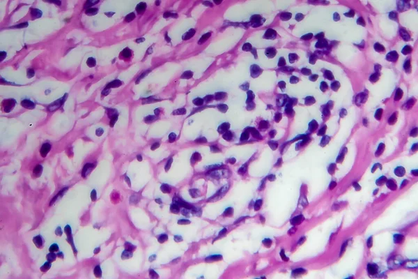 Hodgkin\'s lymphoma, light micrograph, photo under microscope. High magnification