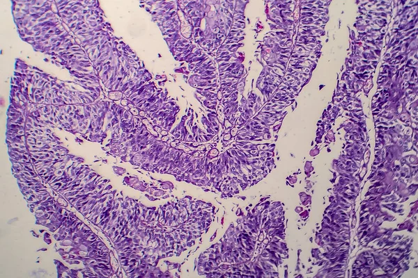 Rak Przejściowokomórkowy Pęcherza Moczowego Mikrograf Świetlny Zdjęcie Pod Mikroskopem — Zdjęcie stockowe