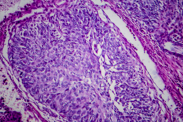Bladder transitional cell carcinoma, light micrograph, photo under microscope