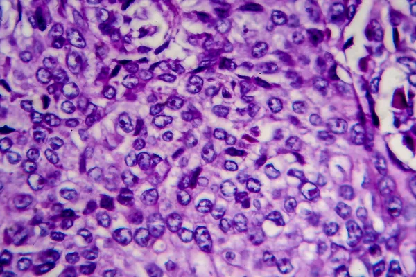 Bladder transitional cell carcinoma, light micrograph, photo under microscope. High magnification