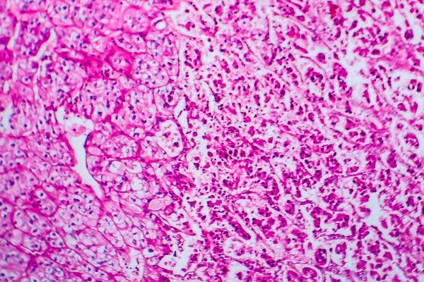 Carcinoma Células Renais Micrografia Luz Foto Sob Microscópio — Fotografia de Stock