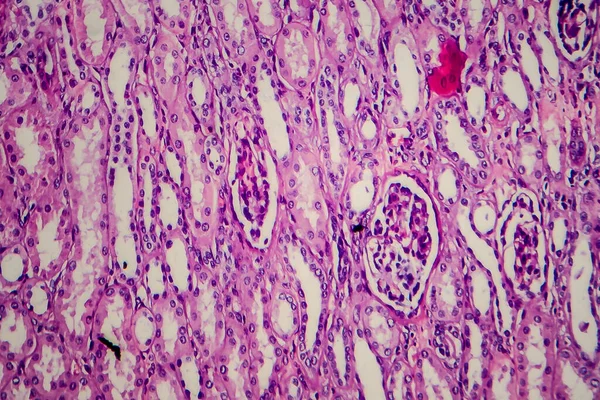 肾母细胞瘤 显微镜下照片 — 图库照片