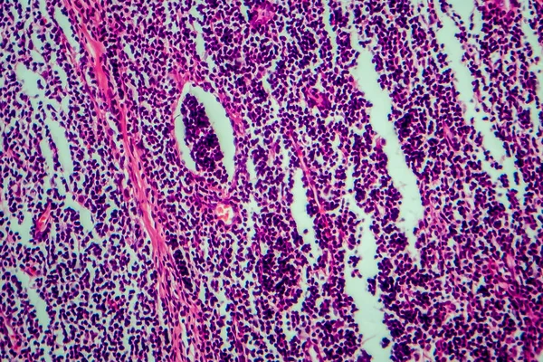 Hodgkin Lenfoması Hafif Mikrograf Mikroskop Altında Fotoğraf — Stok fotoğraf