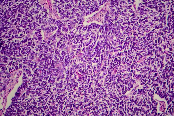 Tumor Wilms Nefroblastoma Micrografía Ligera Foto Bajo Microscopio — Foto de Stock