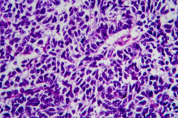 Tumor Wilms Nefroblastoma Micrografia Luz Foto Sob Microscópio Elevada Ampliação — Fotografia de Stock