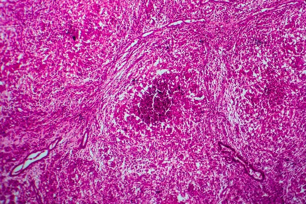 Renální Tuberkulóza Světelný Mikrograf Fotografie Pod Mikroskopem — Stock fotografie