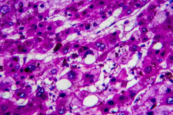 Histopathology of alcoholic hepatitis, light micrograph, photo under microscope. High magnification