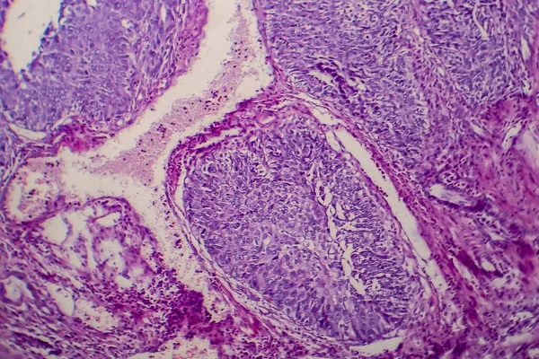 Rak Przejściowokomórkowy Pęcherza Moczowego Mikrograf Świetlny Zdjęcie Pod Mikroskopem — Zdjęcie stockowe
