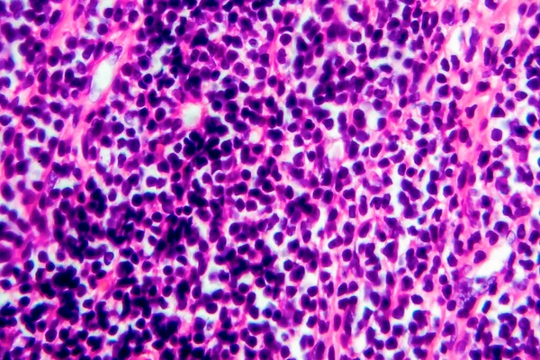 Hodgkin lenfoması, hafif mikrograf, mikroskop altında fotoğraf.