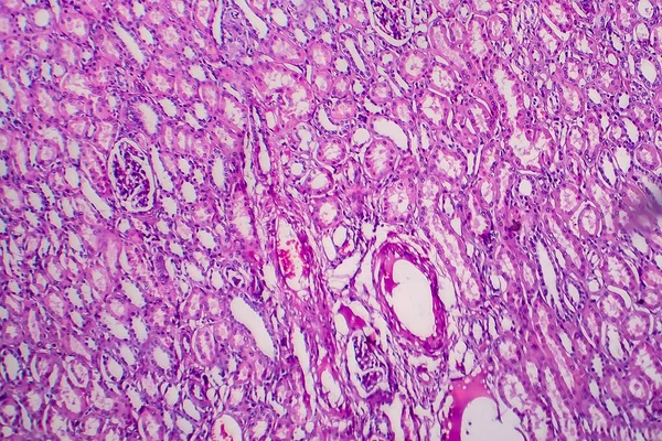 Tumor Wilms Nefroblastoma Micrografía Ligera Foto Bajo Microscopio —  Fotos de Stock