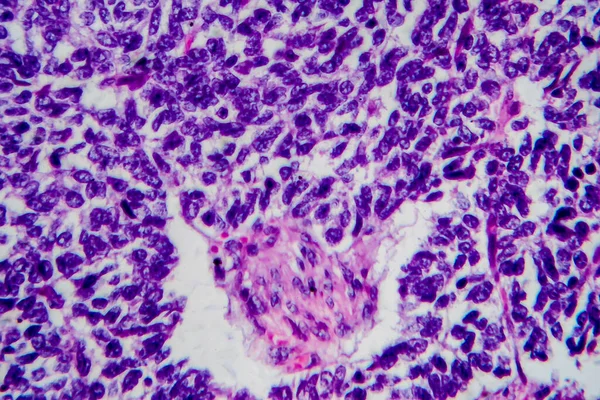 Wilms tumor, or nephroblastoma, light micrograph, photo under microscope. High magnification